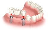 Thoi gian cay ghep implant phai mat bao lau hinh ava