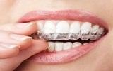 Nieng rang invisalign hinh ava