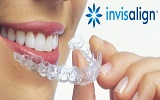 Chinh nha bang khay invisalign ava