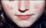 Benh lupus ban do he thong ava