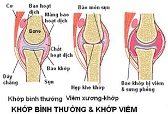 7 trieu chung viem khop thuong gap ban can canh giac1